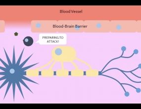 Neuron : Multiple Sclerosis and the Myelin Sheath